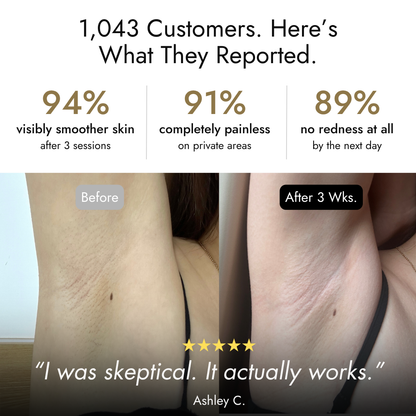 SnowSkyn IPL Device - Fast, Painless Hair Removal