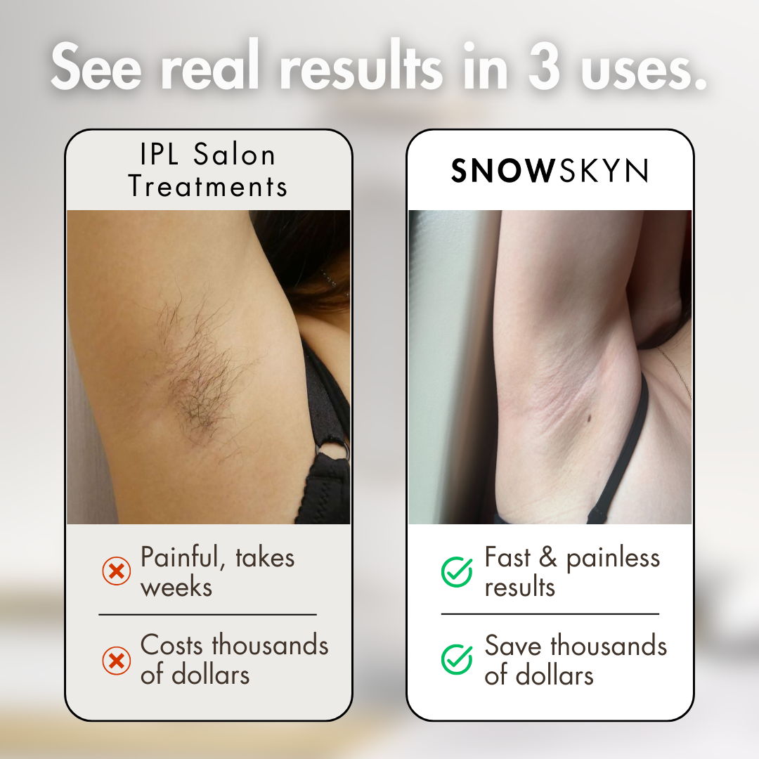 SnowSkyn IPL Device - Fast, Painless Hair Removal